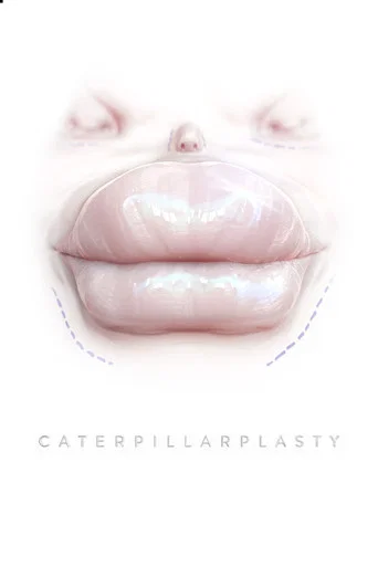 Movie poster for Caterpillarplasty (2018)