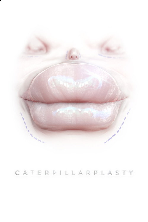 Movie poster for Caterpillarplasty (2018)