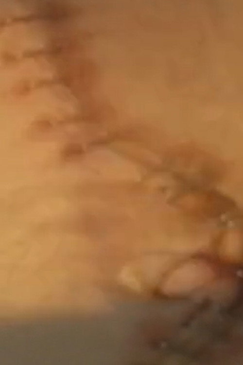 Movie poster for Suite: Double Nephrectomy (1998)